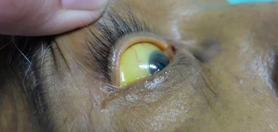 علامات اليرقان وأسبابه