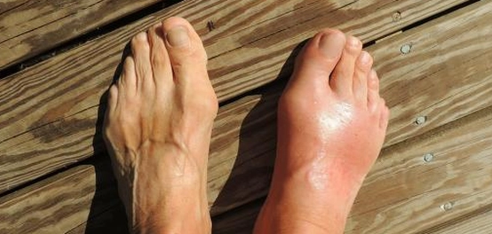 أعراض النقرس لدى الرجال: دليل شامل
