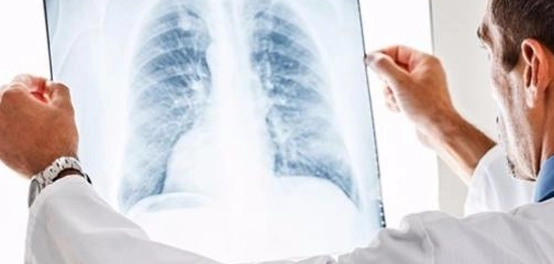 علامات تمزق الرئة: دليل شامل