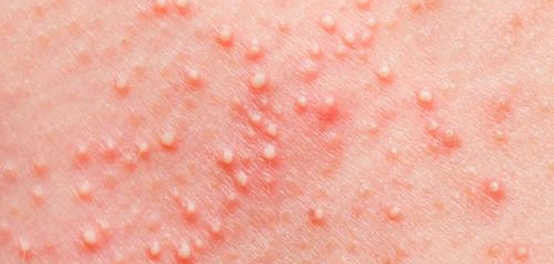 أنواع حب الشباب وطرق علاجه