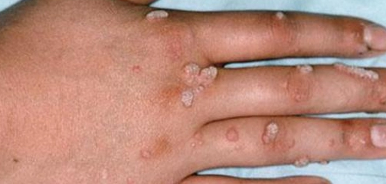 أنواع الثآليل الجلدية: دليل شامل