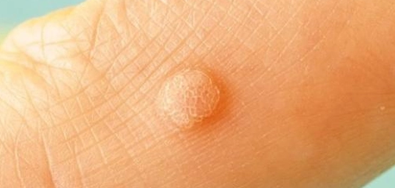 دليل شامل لفهم وعلاج مرض الثآليل