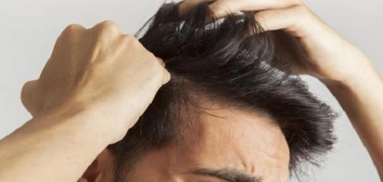 علاج قشرة الشعر: أنواعها وأسبابها وطرق التخلص منها