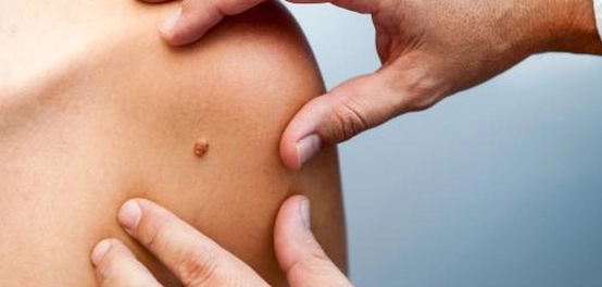 أنواع سرطان الجلد: دليل شامل