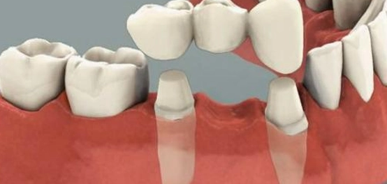 بدائل الأسنان: أنواعها، أسباب استخدامها، والعناية بها