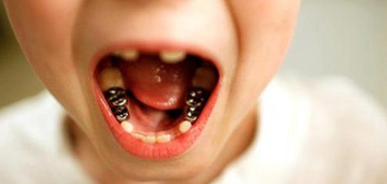 مشاكل تآكل الأسنان: الأسباب، الأنواع، والعلاج
