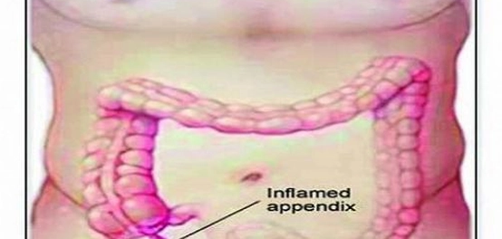 موقع الزائدة الدودية وعلامات التهابها