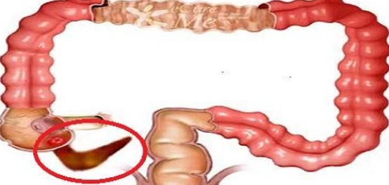 موقع الزائدة الدودية وأهميتها وأمراضها