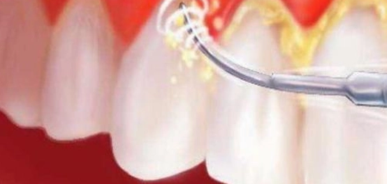 علاج تراكم الجير على الأسنان بالطرق الطبيعية