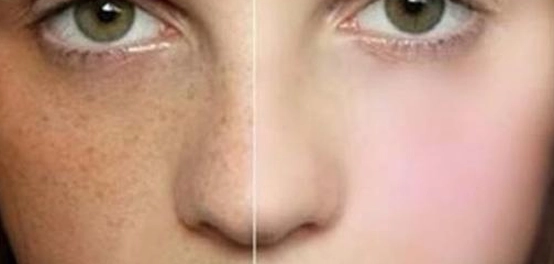 تجربة فعّالة لإزالة النمش بالليزر