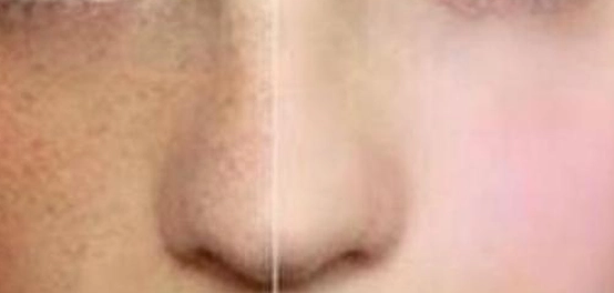 التخلص من الكلف والبقع الداكنة