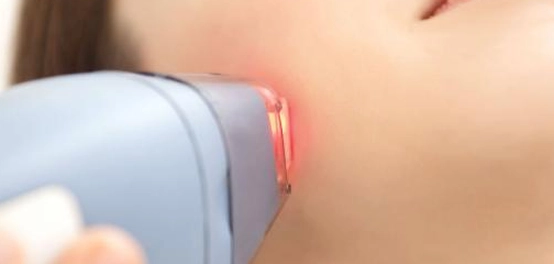 تجربة إزالة الشعر بالليزر: دليل شامل