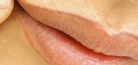 إزالة الشامات من الوجه: دليل شامل