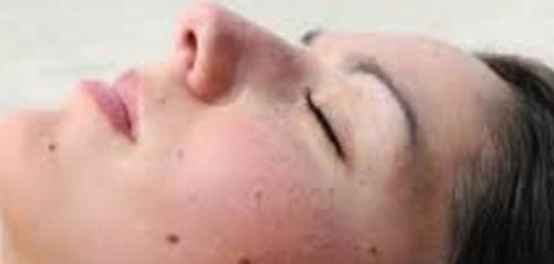 إزالة الشامات بالليزر: دليل شامل