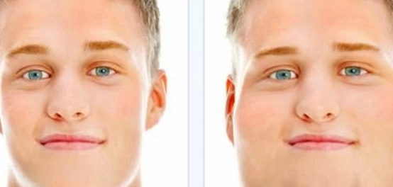 التخلص من دهون منطقة الذقن