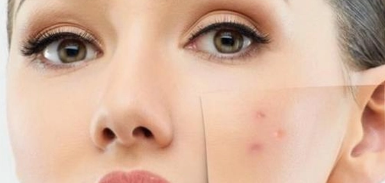 طرق التخلص من حب الشباب على الجسم