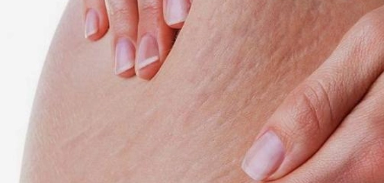 التخلص من خطوط التمدد البيضاء: دليل شامل