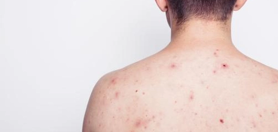 طرق فعّالة للتخلص من آثار حب الشباب