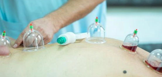 الحجامة: دليل شامل للعلاج التقليدي