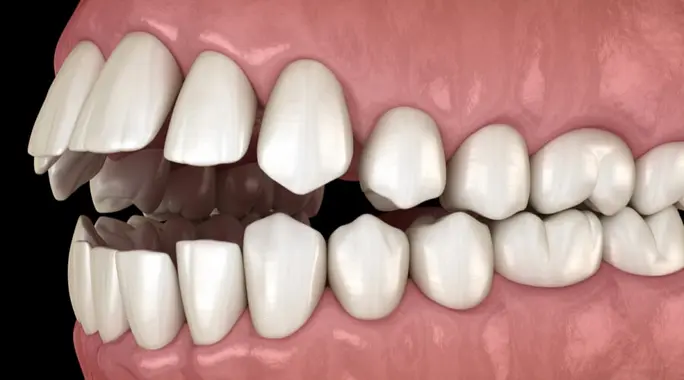 سوء الإطباق السني: اكتشف الأسباب الخفية والعادات اليومية التي تؤثر على ابتسامتك