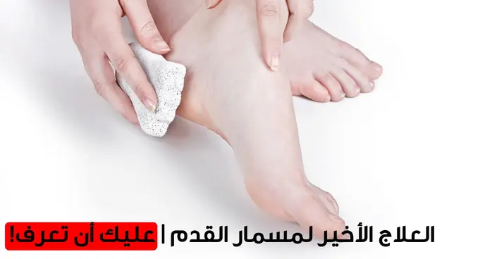 وداعاً لألم مسمار القدم: دليلك الشامل للأسباب والعلاج المنزلي والوقاية
