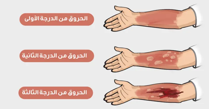 درجات الحروق ونصائح لعلاجها: دليلك الشامل للعناية الفعالة