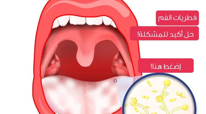 علاج فطريات الفم: طرق فعالة وحلول منزلية للتخلص منها بسرعة