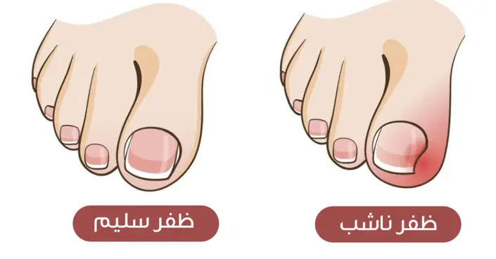 الظفر الناشب: دليل شامل للأسباب، العلاج المنزلي والوقاية