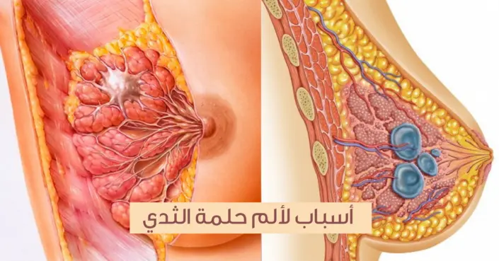ألم حلمة الثدي: 8 أسباب شائعة تحتاجين معرفتها وكيفية التعامل معها