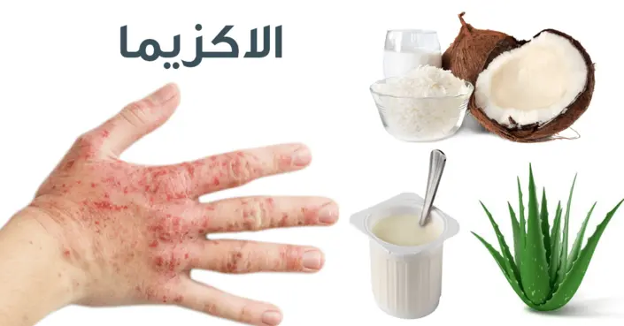 طرق علاج الأكزيما في المنزل: خيارات طبيعية وفعالة لتخفيف الحكة