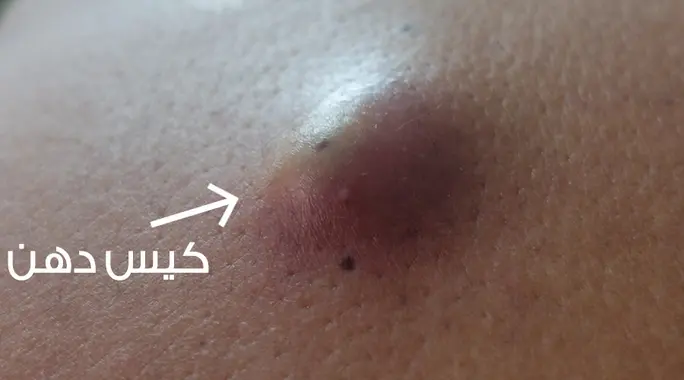 الكيس الدهني: دليلك الشامل لأسباب ظهوره، أعراضه، وطرق علاجه الفعّالة