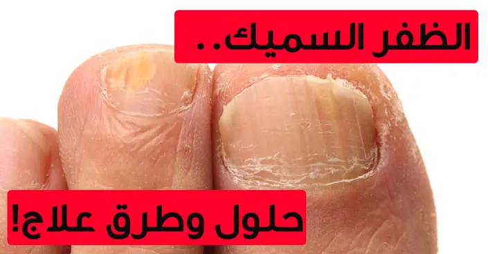 Thick Nails: Uncovering the Causes, Symptoms, and Effective Treatment Solutions