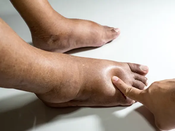 احتباس السوائل في الجسم: دليلك الشامل لفهم الوذمة وعلاجها بفعالية
