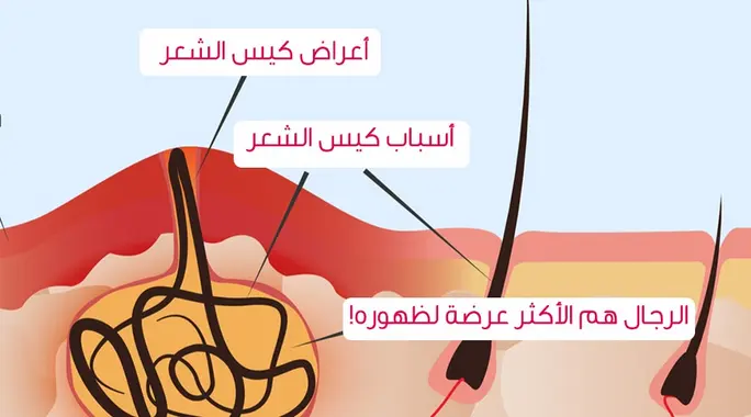 كيس الشعر: دليلك الشامل لأسباب ناسور العصعص، أعراضه، وطرق العلاج الفعالة