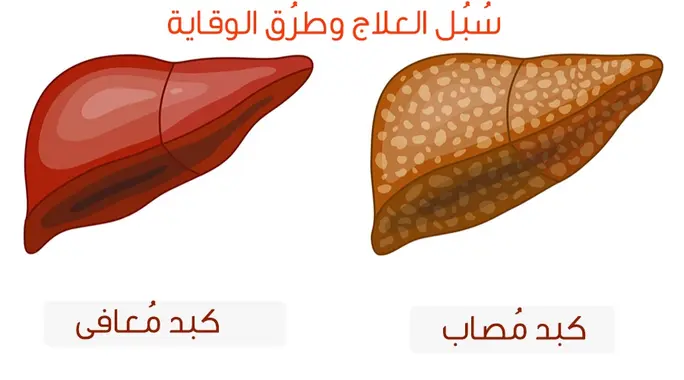 علاج دهون الكبد بطرق مختلفة: دليلك الشامل لاستعادة صحة كبدك