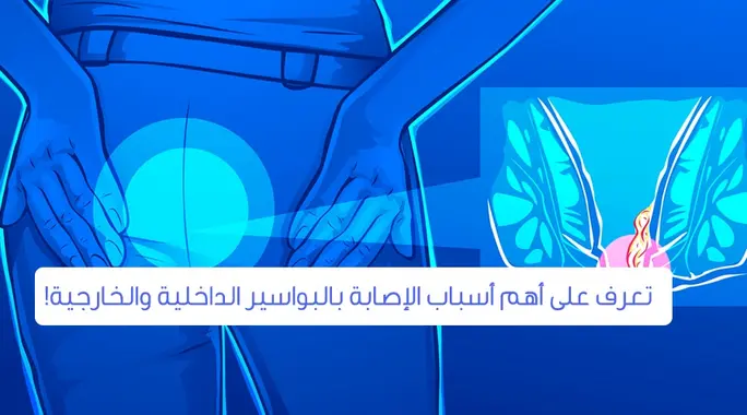 دليل شامل: أسباب الإصابة بالبواسير وطرق الوقاية الفعالة منها