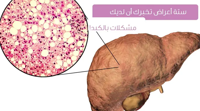 6 أعراض رئيسية لمشاكل الكبد: لا تتجاهل هذه العلامات