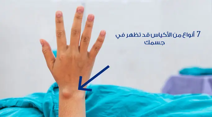 دليل شامل: أنواع الأكياس المختلفة في الجسم وأسباب ظهورها وطرق التعامل معها بفعالية