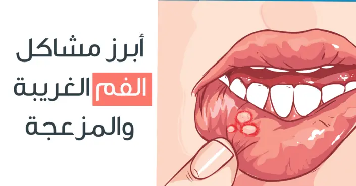 من اللسان الجغرافي لقروح البرد: دليلك لأبرز أمراض الفم الغريبة والمزعجة