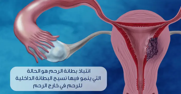 دليل شامل: أهم 10 أسئلة لطرحها على طبيبك حول انتباذ بطانة الرحم