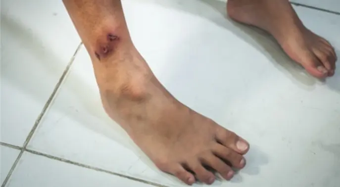 الغرغرينا والسكري: كشف العلاقة والأمراض الأخرى المؤثرة ودليل الوقاية