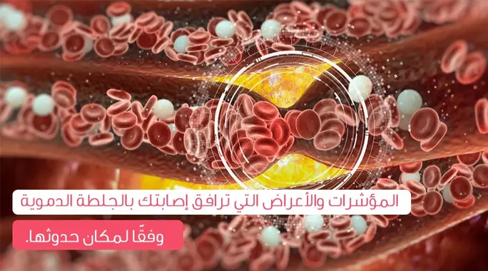 الجلطة الدموية: دليلك الشامل لأماكن تكونها وأعراضها الخطيرة