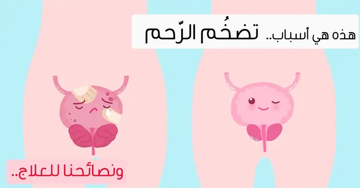 تضخُّم الرحم: دليلك الشامل لفهم الأسباب، الأعراض، والعلاج