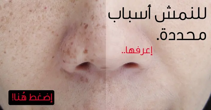النمش: دليل شامل لأسبابه، الوقاية منه، وأبرز الوصفات الطبيعية لعلاجه