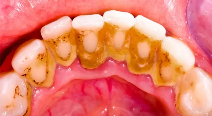 بلاك الأسنان: دليل شامل لأسبابه، علاجه منزليًا، وطرق الوقاية