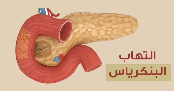 التهاب البنكرياس الحاد: دليل شامل للأعراض والأسباب والعلاج