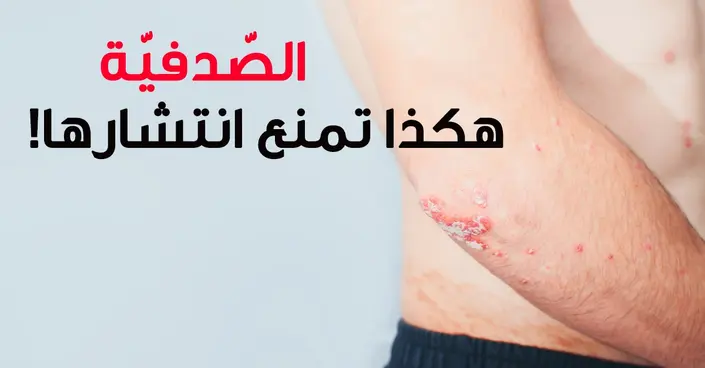 تحكم في الصدفية: 8 طرق فعالة لمنع انتشارها في جسمك والحفاظ على بشرة صحية