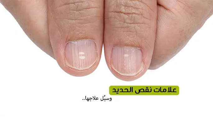 أعراض نقص الحديد في الجسم: دليلك الشامل لفقر الدم وكيفية التعامل معه