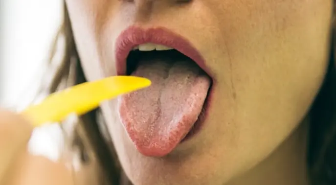 اللسان الأبيض: دليل شامل لأسبابه، علاجه، وطرق الوقاية منه