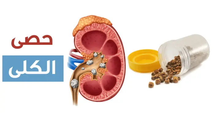 أعراض حصى الكلى: لا تتجاهل هذه العلامات التحذيرية الخطيرة!